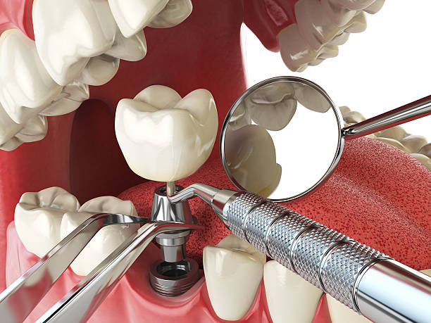 Best Urgent Care for Lost Fillings or Crowns in Blacksburg, VA
