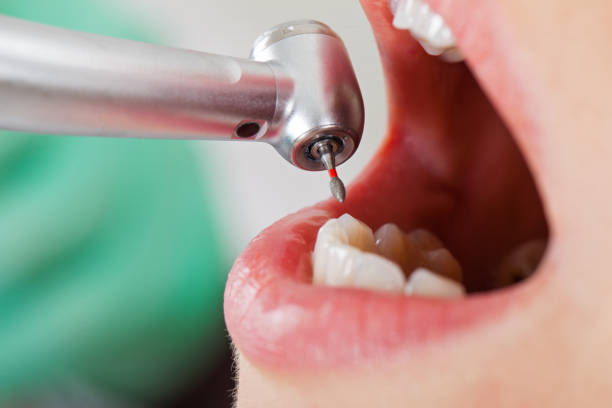 Best Emergency Dental Care for Broken or Chipped Teeth in Blacksburg, VA